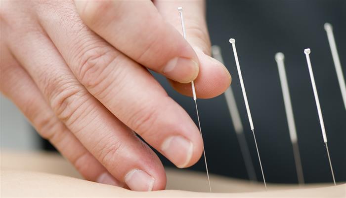 A person getting acupuncture treatment - © zilli